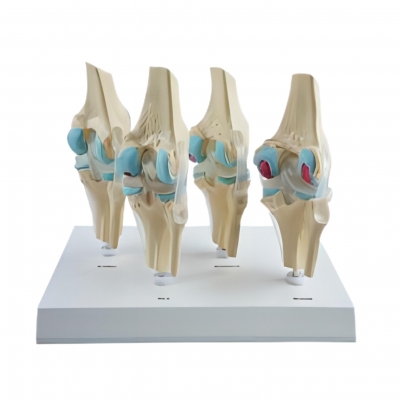 四分型膝關(guān)節(jié)正常膝蓋骨病變組合模型 