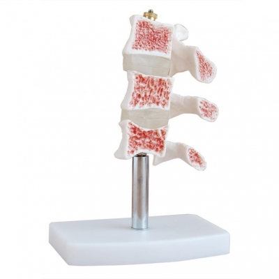 切開型骨質(zhì)疏松癥