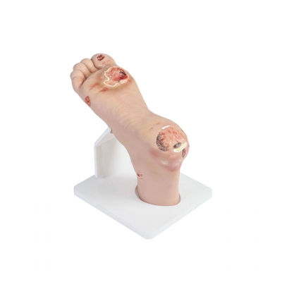 輕癥糖尿病足模型