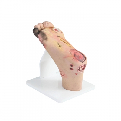 重癥糖尿病足模型