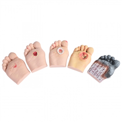 5級程度糖尿病足模型